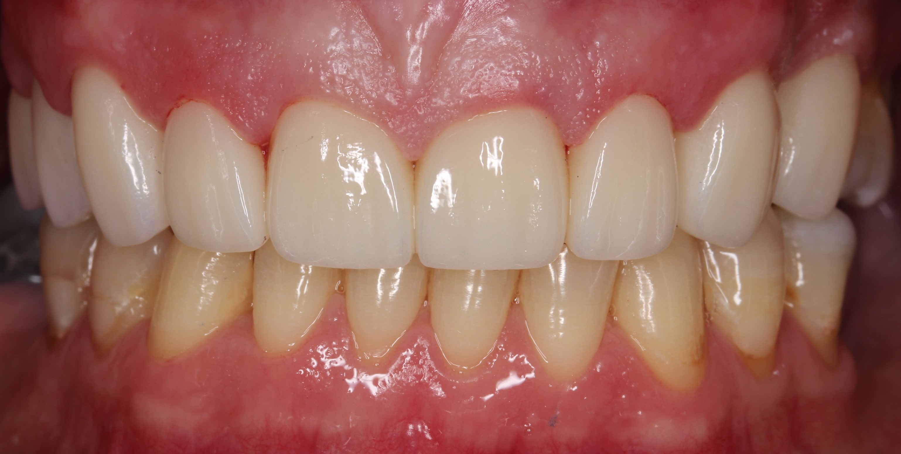  dental veneers Phuket, best dentist in Phuket, dentist Phuket, veneers Phuket